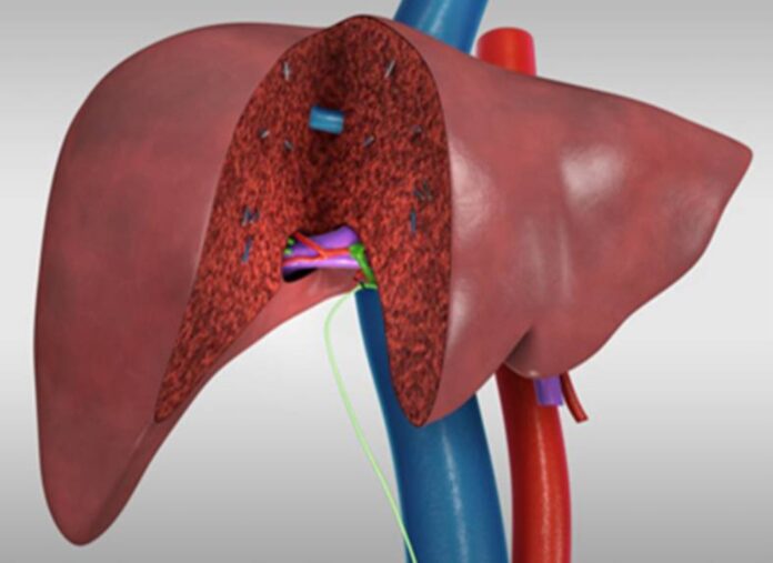 ಬೆಳಗಾವಿ : ತಂದೆಗೆ ಮಗನಿಂದ ಲಿವರ್ ದಾನ &ndash; ಕೆಎಲ್&zwnj;ಇ ಆಸ್ಪತ್ರೆಯಲ್ಲಿ ಯಶಸ್ವಿ ಲಿವರ್ ಕಸಿ ಶಸ್ತ್ರಚಿಕಿತ್ಸೆ